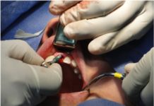 Ce qu’il faut savoir avant de se faire poser un implant dentaire