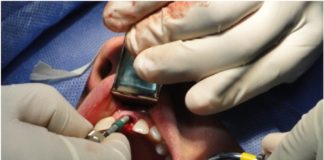 Ce qu’il faut savoir avant de se faire poser un implant dentaire