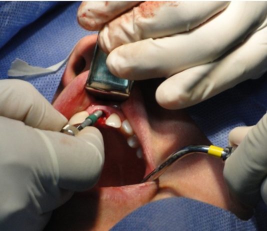 Ce qu’il faut savoir avant de se faire poser un implant dentaire Ce qu’il faut savoir avant de se faire poser un implant dentaire